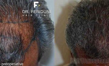 Hair restoration procedure before and postoperative pictures