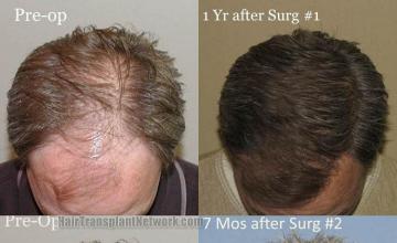 Hair restoration procedure before and after results