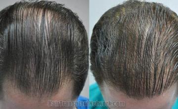 Hair restoration procedure before and after results