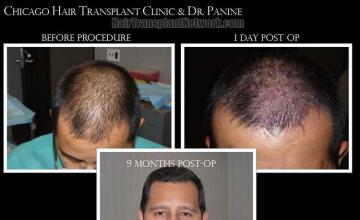 Hair restoration procedure before and after results