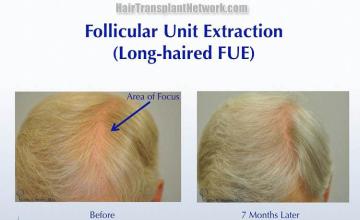 Hair restoration procedure before and after pictures