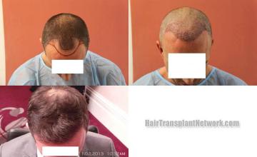 Top view - Before and after surgical hair replacement