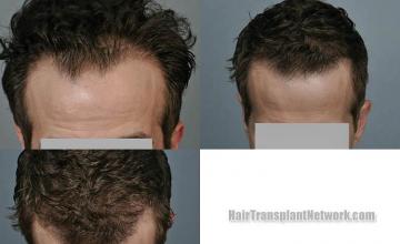 Hair transplantation surgery before and after photos