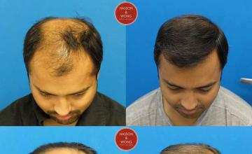 Hair transplantation surgery before and after photos