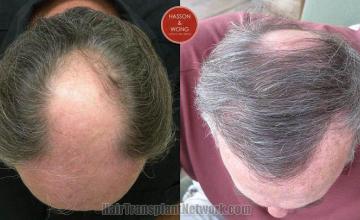 Hair transplantation surgery before and after photos