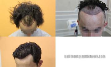 Hair transplantation surgery before and after photos