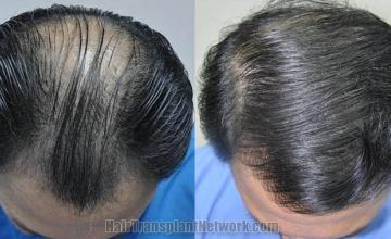 Top view - Before and after surgical hair replacement