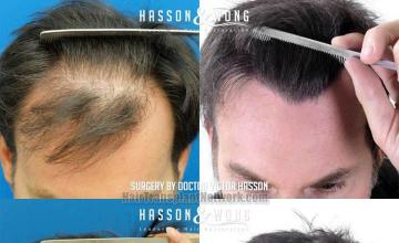 Hair transplantation surgery before and after images