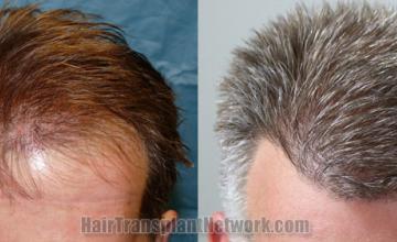 Top view - Before and after hair restoration results