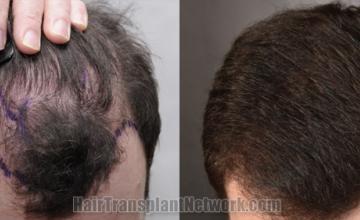 Top view - Before and after hair restoration results