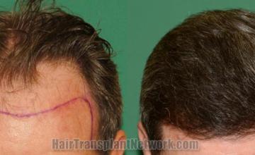 Top view - Before and after hair restoration results