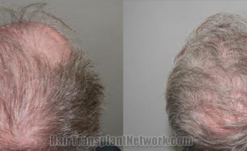 Top view - Before and after hair restoration results