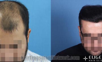  before and after result photographs