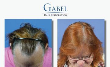 Hair transplantation surgery before and after images