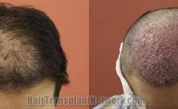 Hair restoration procedure before and after pictures