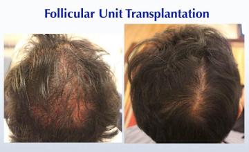 Hair transplantation procedure before and after results