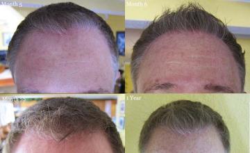 Hair transplantation surgery before and after images