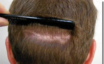 Hair restoration procedure results