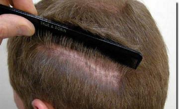 Hair restoration procedure results