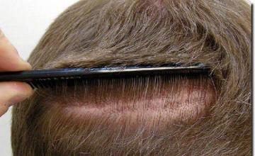 Hair restoration procedure results