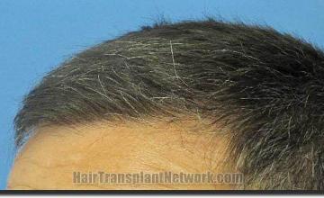 Hair restoration procedure results