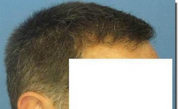 Hair restoration procedure results