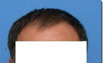 Hair restoration procedure results