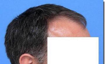 Hair restoration procedure results