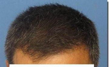 Hair restoration procedure results