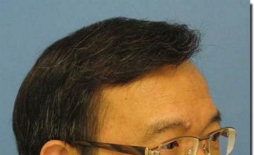 Hair restoration procedure results