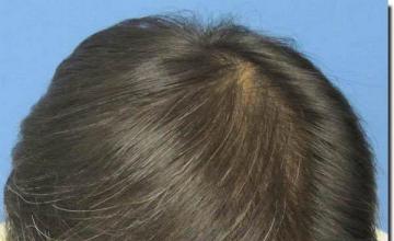 Hair restoration procedure results