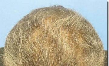 Hair restoration procedure results