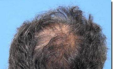 Hair restoration procedure results