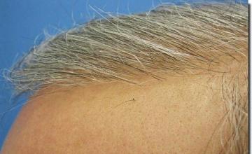 Hair restoration procedure results