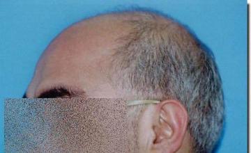 Hair restoration procedure results