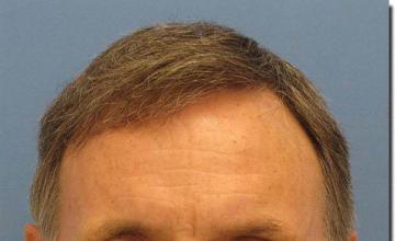 Hair restoration procedure results