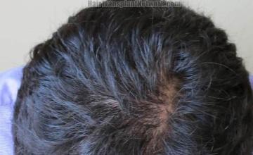 Hair transplantation surgery before and after images