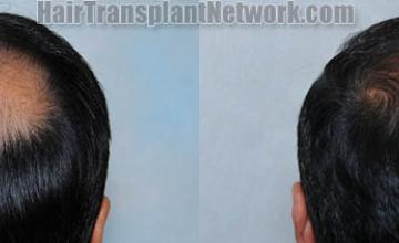 Hair replacement surgery before and after images