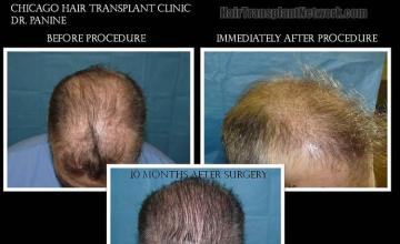 Hair transplantation surgery before and after photos