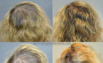 Surgical hair transplantation result photographs