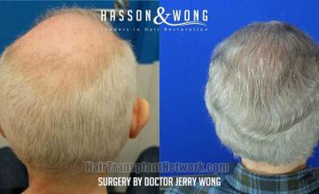 Hair replacement surgery before and after images