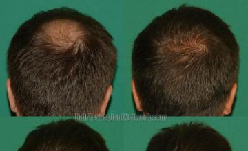 Hair restoration procedure before and after results