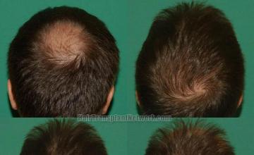 Hair transplantation surgery before and after photos