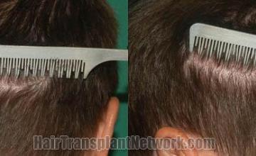 Hair transplantation surgery before and after pictures