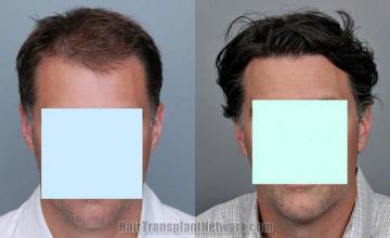 Hair restoration procedure before and after results