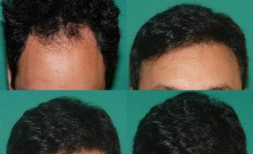 Before and after hair transplant procedure images