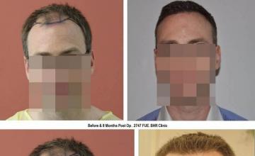 Hair restoration procedure before and after results