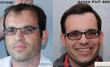 Hair restoration procedure before and after results