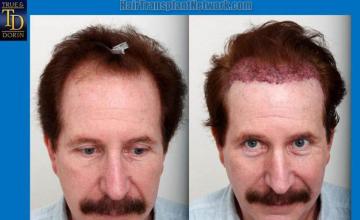 Hair restoration procedure before and after results