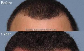 Hair transplant surgery before and after photos